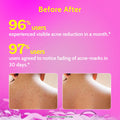 Chemist at Play 1% Salicylic Acid Body Wash for Acne Control - 236 ml