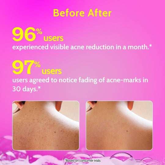 Chemist at Play 1% Salicylic Acid Body Wash for Acne Control - 236 ml