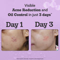 Chemist at Play 2% Salicylic Acid Face Serum for Acne Control - 30 ml