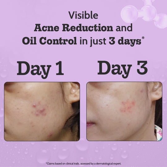 Chemist at Play 2% Salicylic Acid Face Serum for Acne Control - 30 ml