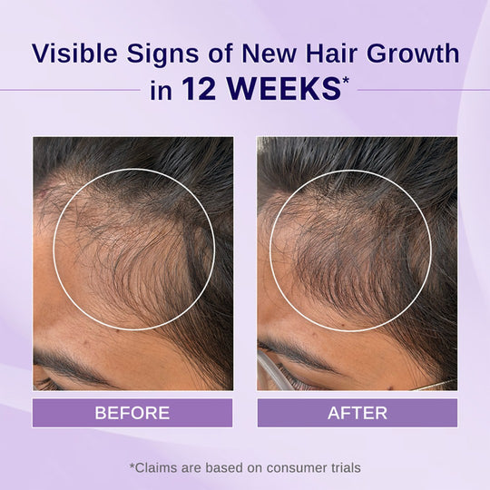Bare Anatomy Rosemary & Hibiscus Hair Growth Oil - 100 ml