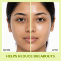Forever 52 Acne Care Hydrating Moisturiser